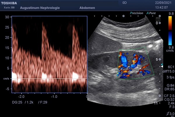 Screenshot einer Computertomographie des Bauchraums mit Hervorhebung der Nieren